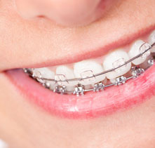 brackets